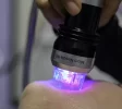 microneedling Groningen